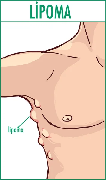 Illustrazione vettoriale di un lipoma . — Vettoriale Stock