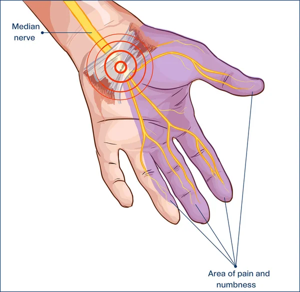 Ligamento carpiano transversal comprimido mano del nervio mediano — Vector de stock