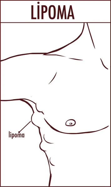 Vector illustration of a lipoma. — Stock Vector