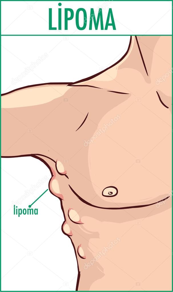  vector illustration of a lipoma.