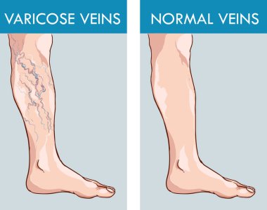 Illustration of a healthy leg and the affected varicose veins clipart