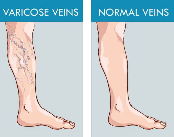 Ilustración de una pierna sana y las venas varicosas afectadas — Archivo Imágenes Vectoriales