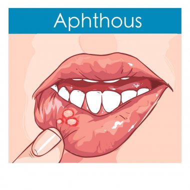  vector illustration of a Woman with aphthae on lip. clipart