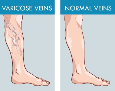 miometric varicoseza varicos după naștere