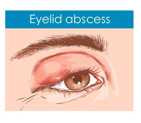 Close-up de um olho com uma pálpebra infectada — Vetor de Stock