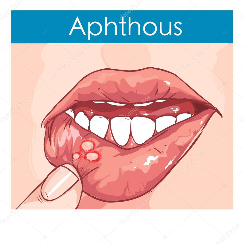  vector illustration of a Woman with aphthae on lip.