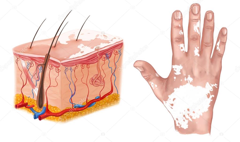 medical Illustration of the effects of vitiligo
