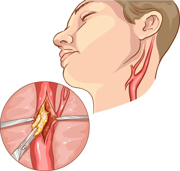 Illustration vectorielle d'une endoctérectomie carotidienne — Image vectorielle