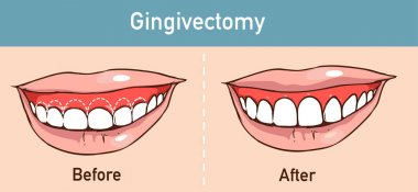  bir Gingivectomy vektör çizim 