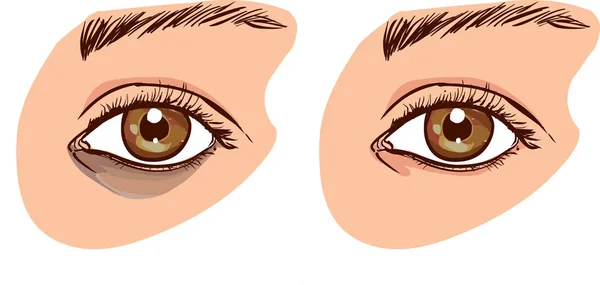 La cara de la mujer con ojeras bajo los ojos. El concepto El concepto de cuidado de la piel de los ojos. antes y después — Vector de stock