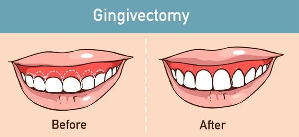 Ilustración vectorial de una gingivectomía — Vector de stock