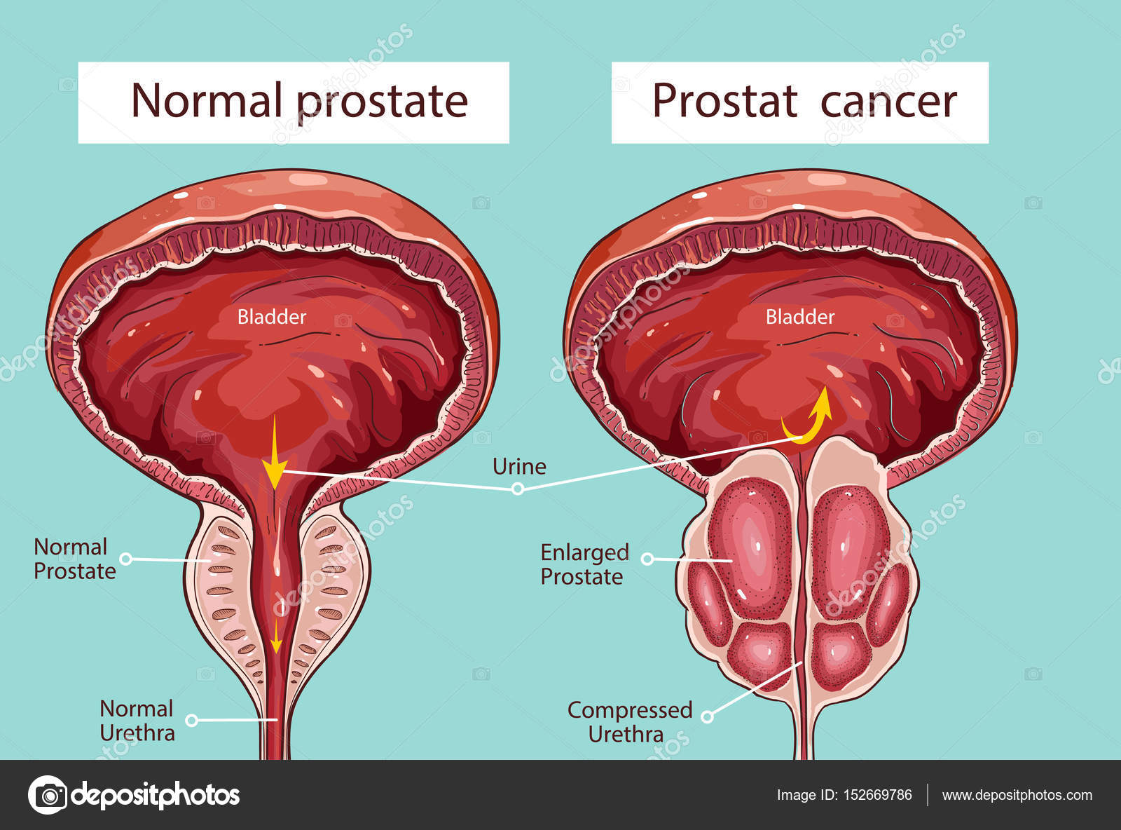 Nasvay prostatitis