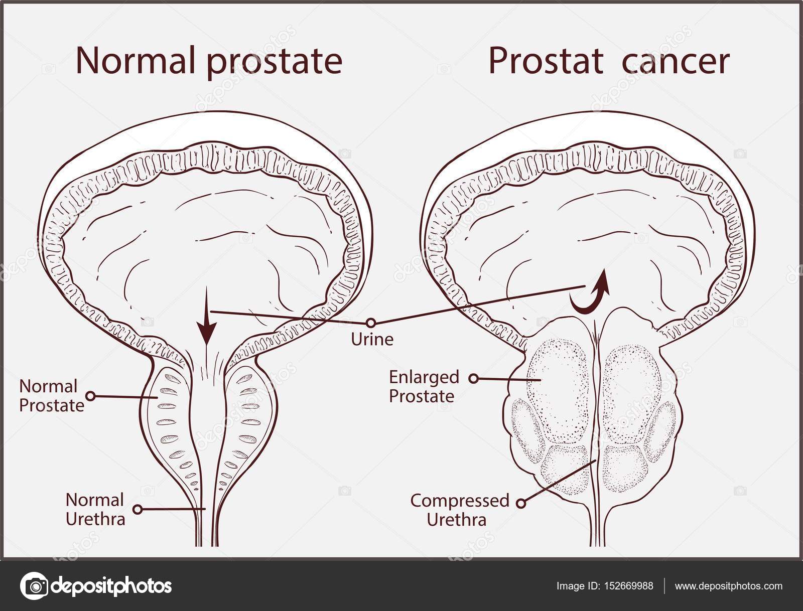Normal prostate and acute prostatitis. Medical illustration Stock ...