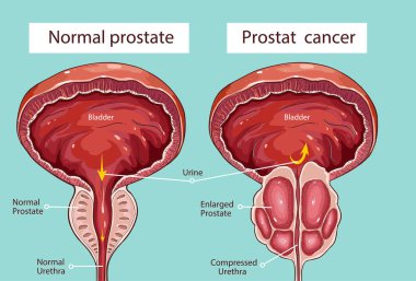 normal prostate and acute prostatitis. Medical illustration clipart