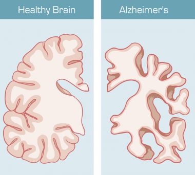Alzheimer hastalığı beyni etkileyen bir tıbbi durumdur