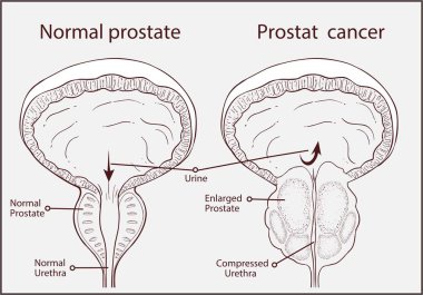 Prostatitis vesiculitis népi jogorvoslatok)
