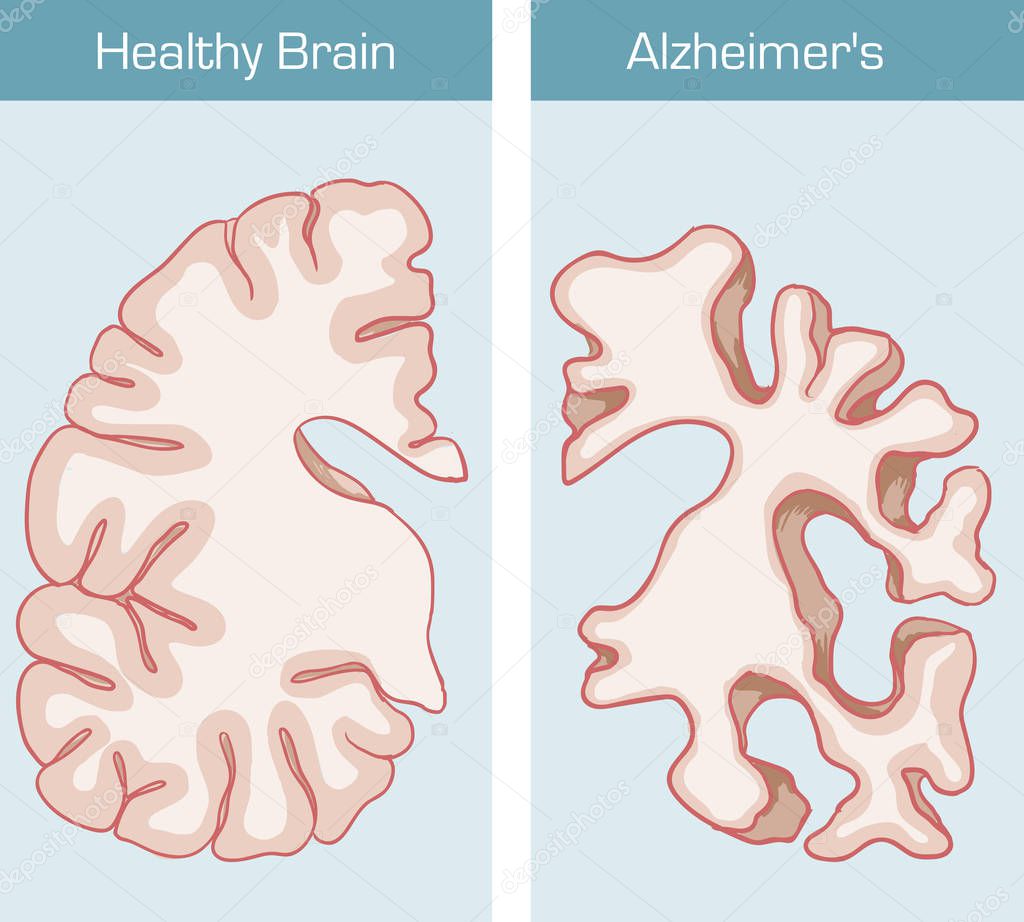 Alzheimer's Disease is a medical condition affecting the brain