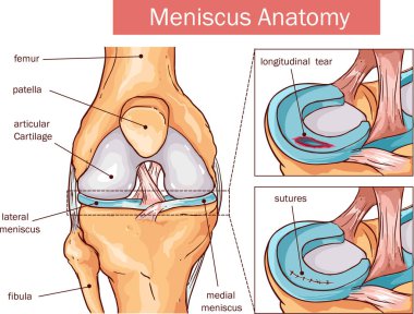  vector illustration of a Meniscus tear and surgery clipart