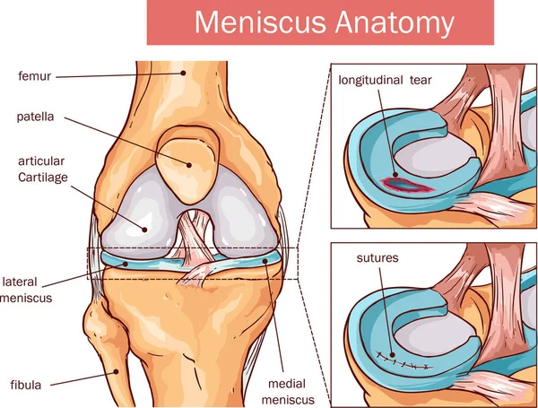 Vektoros illusztráció a Meniscus-szakadás és a műtét — Stock Vector