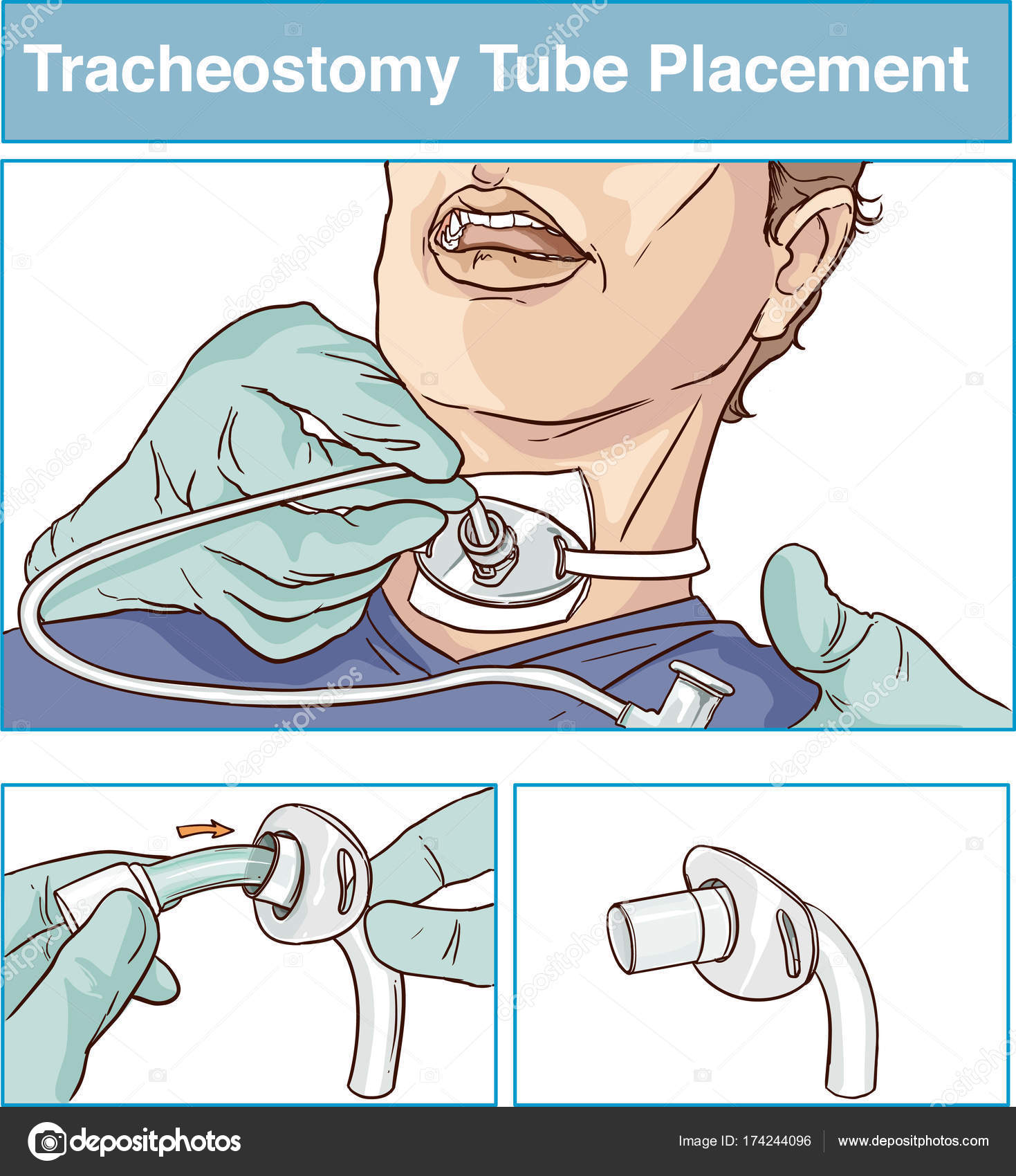 Vector illustration of a tracheostomy tube placement Stock Vector Image by  © #174244096