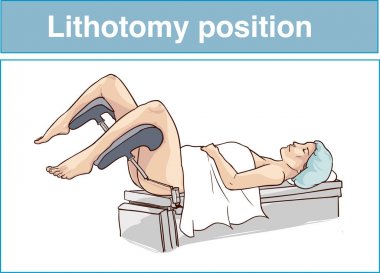  litotomi pozisyonu vektör çizim