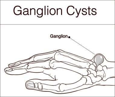 Ganglion kisti vektör çizim