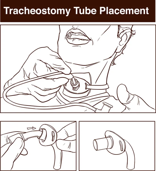 벡터 일러스트 레이 션의 tracheostomy 관 배치 — 스톡 벡터