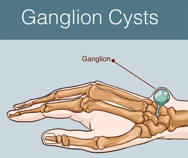 Vectorillustratie van een Cyste Ganglion — Stockvector