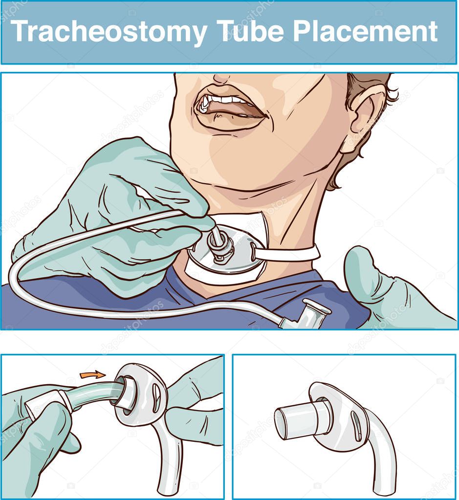  vector illustration of a tracheostomy tube placement