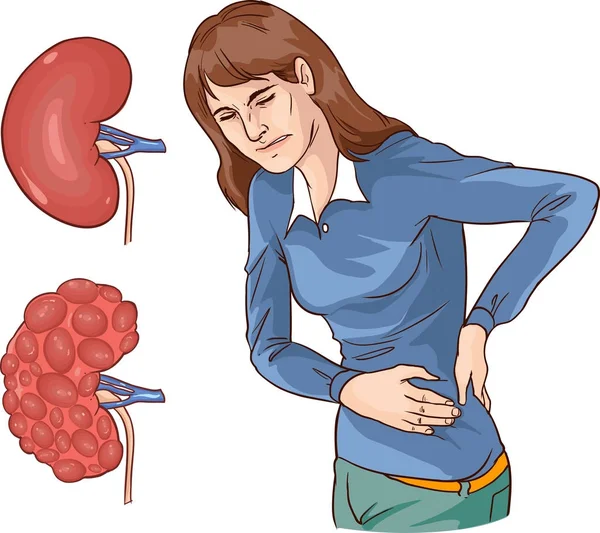 Vector Illustration Chronic Kidney Disease — Stock Vector