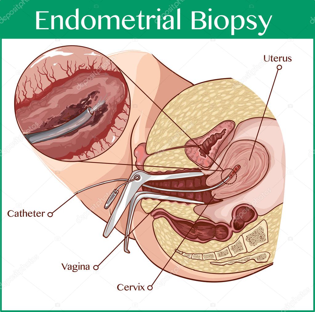 Cross section biomedical illustration of endometrial biopsy