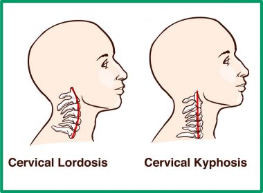 Normal vs servikal lordoz iptali