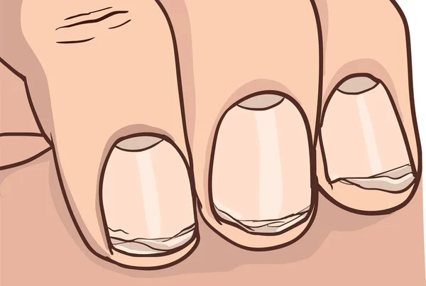 Illustration d'ongles sains et cassés — Image vectorielle