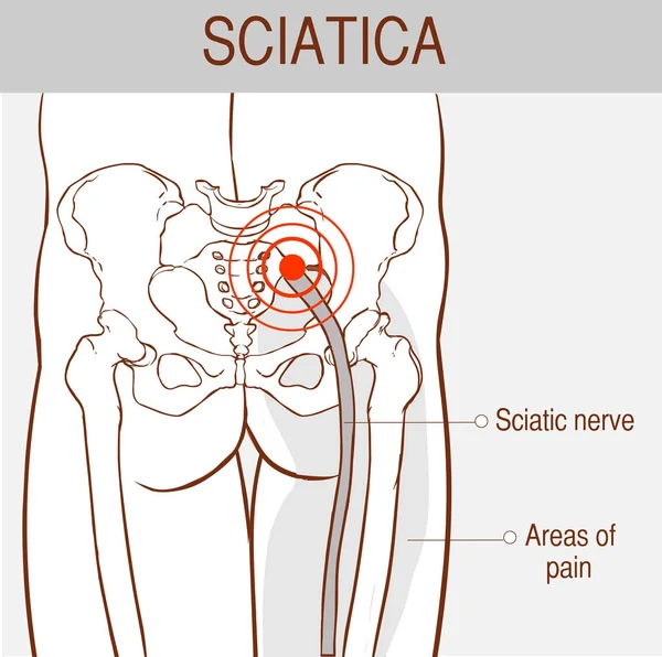 Medical Illustration Symptoms Sciatica — Stock Vector