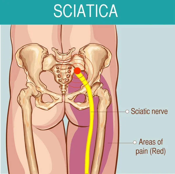 Medical illustration of symptoms of sciatica — Stock Vector