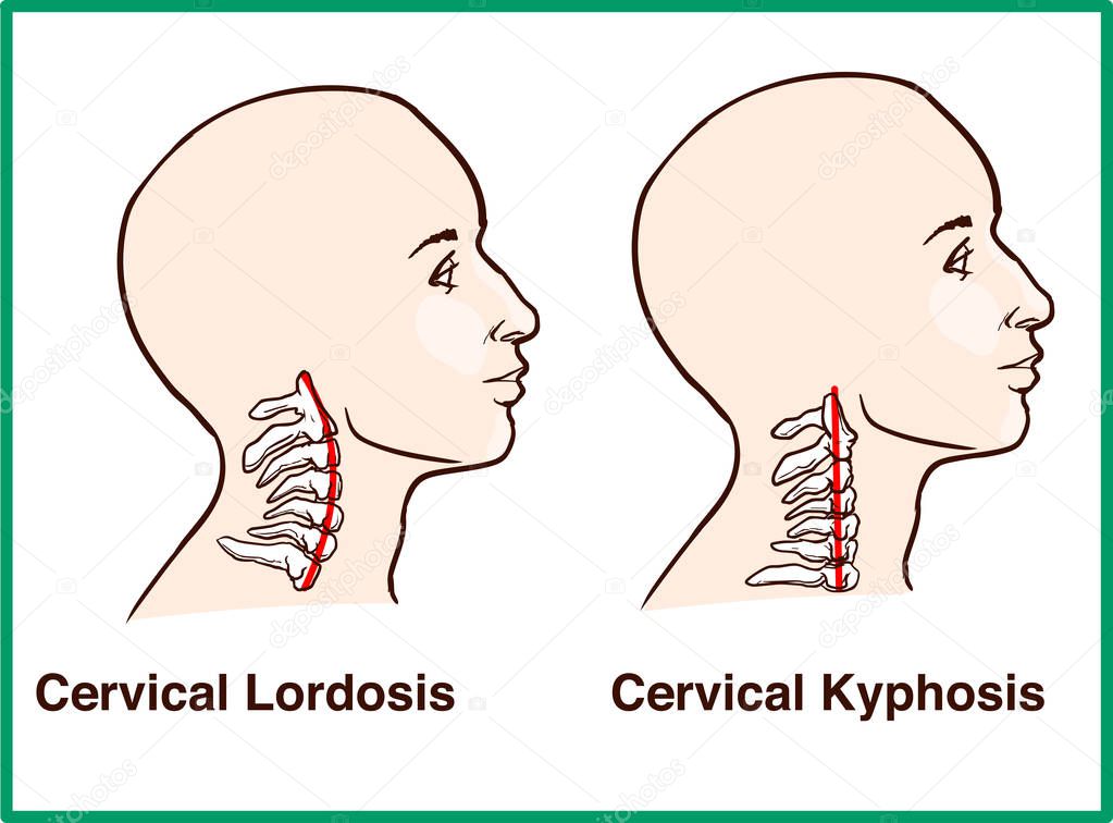 Normal vs. Reversal of Cervical Lordosis