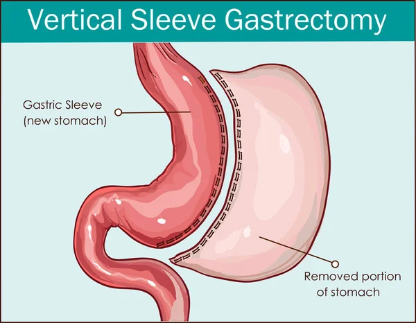 Vektor ilustrasi dari gastrectomy lengan vertikal - Stok Vektor