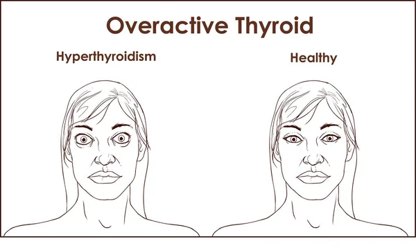 Rostro Una Mujer Adulta Que Muestra Los Síntomas Del Hipertiroidismo — Vector de stock