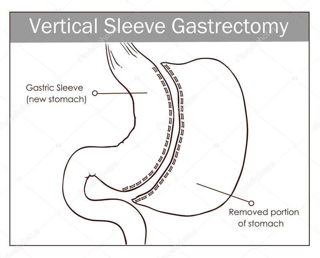 Vector illustration of Vertical Sleeve Gastrectomy
