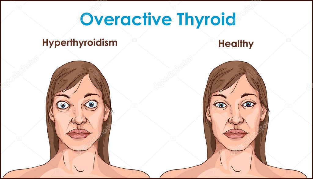 Face of an adult female exhibiting the symptoms of hyperthyroidism.