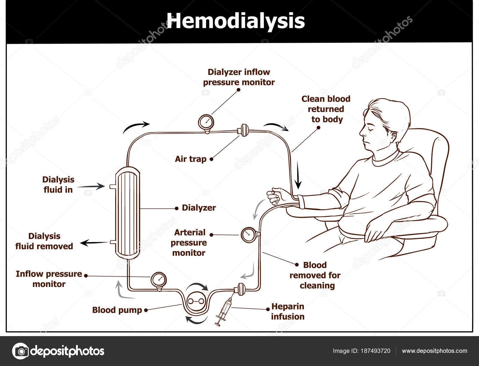Hemodialysis Procedure Used Renal Insufficiency Stock Vector Image by  © #187493720