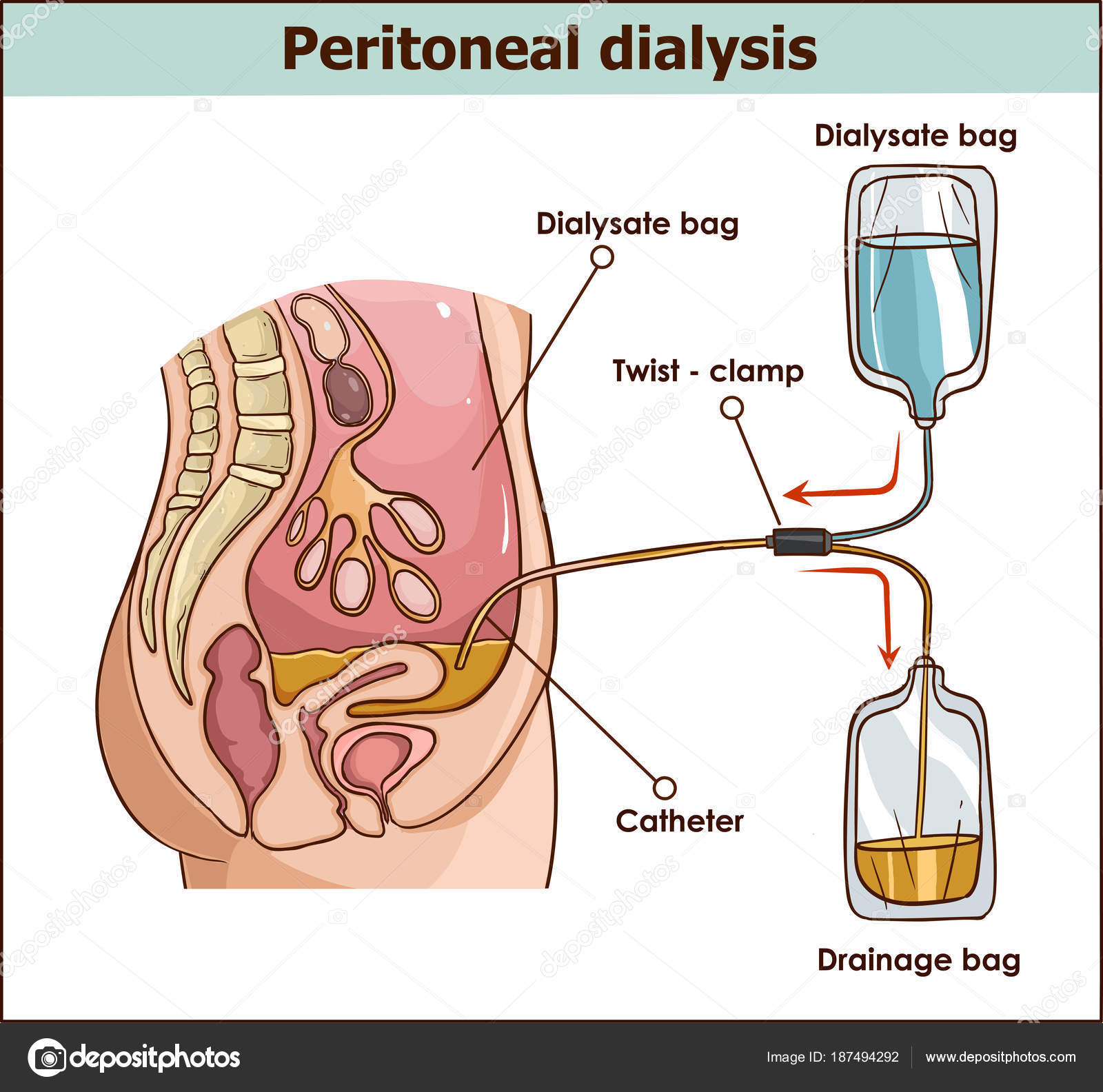 Peritoneal dialysis are both used to treat kidney - vector illus Stock Vector Image by © #187494292 Peritoneal dialysis are both used to treat kidney - vector illus Stock Vector Image by © #187494292