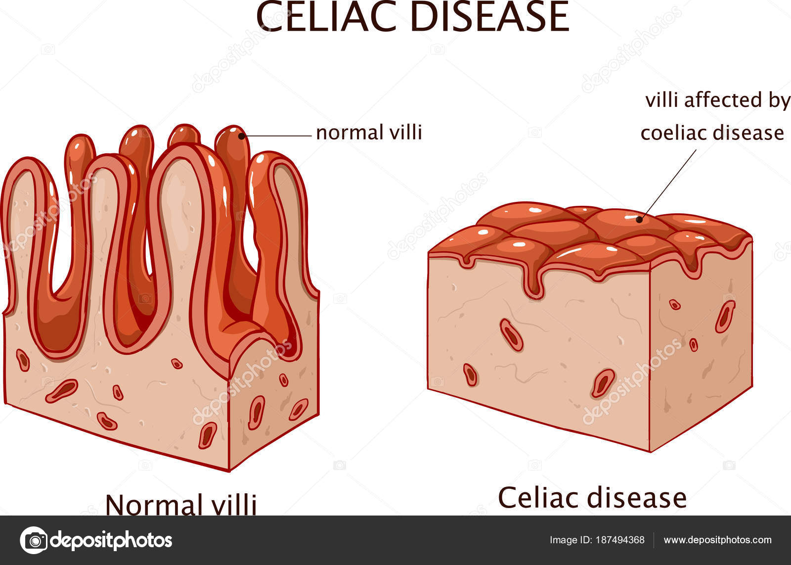 Resultado de imagen de celiacos