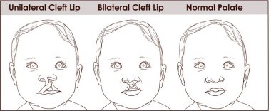 illustration of a cleft palate in a child. plastic surgery. reco clipart