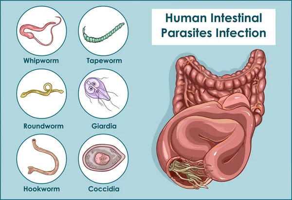 Illustrazione vettoriale di un parassita intestinale umano — Vettoriale Stock
