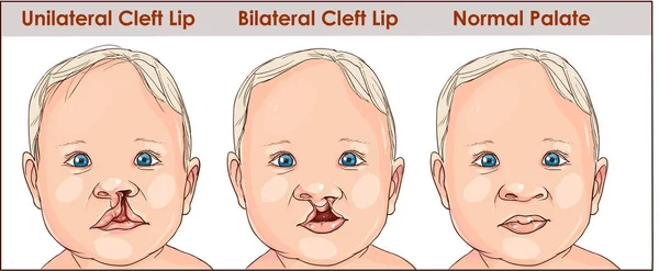 Illustrazione di una palatoschisi in un bambino. chirurgia plastica. reco — Vettoriale Stock