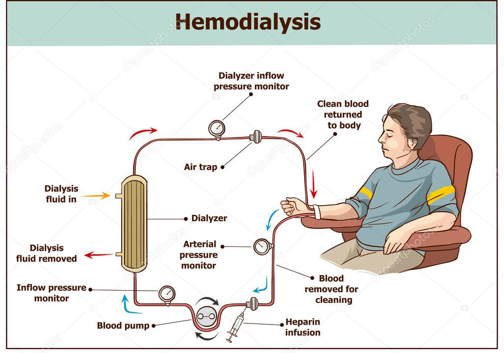 Hemodialysis procedure. Used for the renal insufficiency.