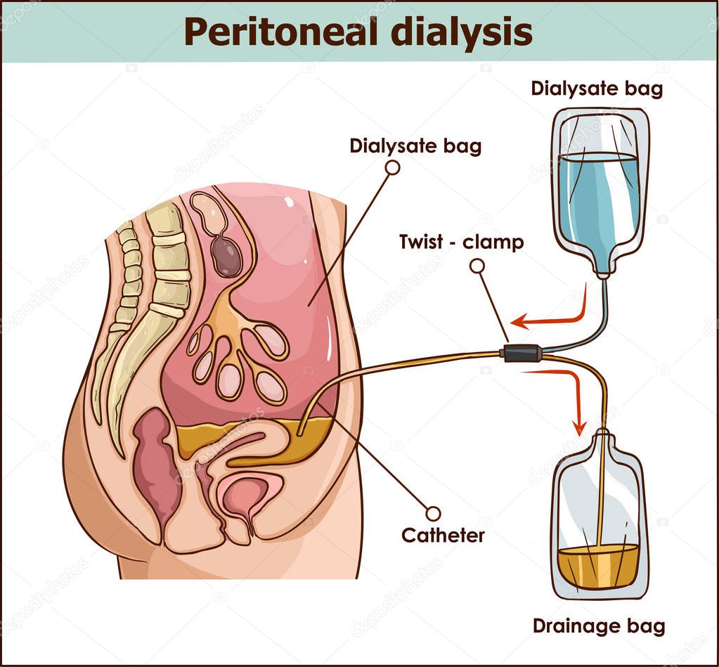 peritoneal dialysis are both used to treat kidney - vector illus