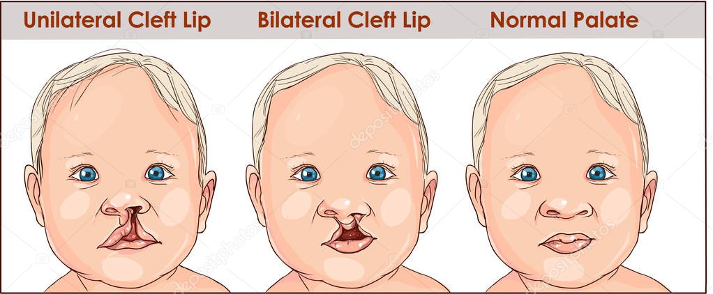 illustration of a cleft palate in a child. plastic surgery. reco