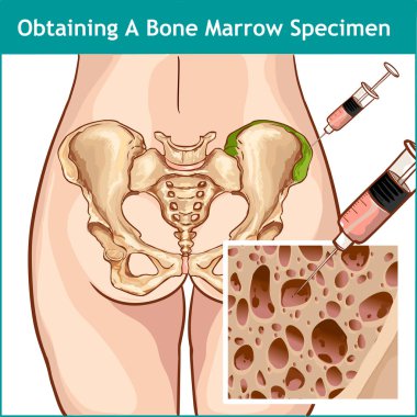  VECTOR ��LLUSTRAT��ON OF A BONE MARROW ASPIRATION clipart